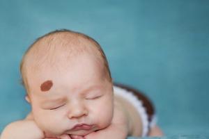 Khám Phá Ý Nghĩa Vết Bớt Trên Cơ Thể