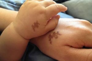 Mối Liên Hệ Giữa Vết Bớt Và Tiền Kiếp